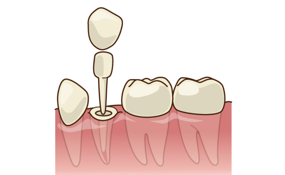ファイバーコア