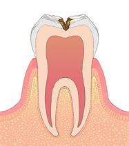 C2 虫歯菌が歯の象牙質まで広がった状態