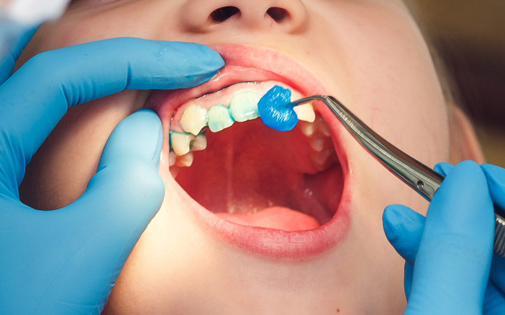 フッ素塗布（フッ素化物）